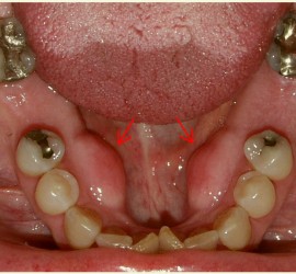 Экзостозы нижней челюсти симметричные