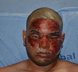 Ожог лица электрическим током