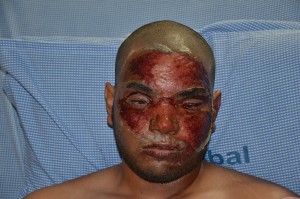 Ожог лица электрическим током