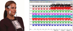 Электромиография