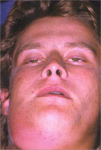 Флегмона челюстно-лицевой области