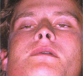 Флегмона челюстно-лицевой области