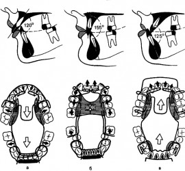 Соотношение зубных рядов и типы формирователей прикуса Бимлера для лечения дистального прикуса, сочетающегося с протрузией (а) и ретрузией (б) верхних передних зубов, а также для лечения мезиального прикуса (в).