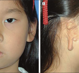 Гемифациальная микросомия (отокраниостеноз)