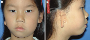 Гемифациальная микросомия (отокраниостеноз)