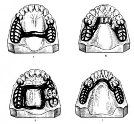 Каркасы дуговых протезов.