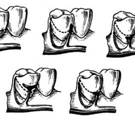 Кламмер Роуча