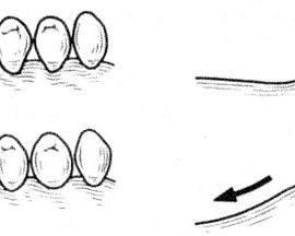 Классификация беззубых альвеолярных отростков при концевых изъянах (по Эльбрехту). Стрелками указаны направления движения седла протеза в зависимости от формы альвеолярного отростка.