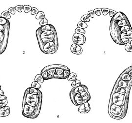 Классификация зубных рядов с дефектами Гаврилова