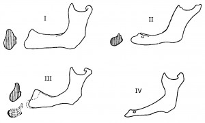Классификация нижних беззубых челюстей Келлера