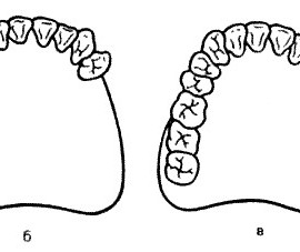 Классификация зубных рядов с дефектами Кеннеди