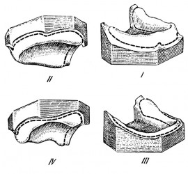 Классификация беззубых челюстей Оксмана