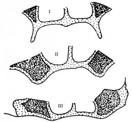 Классификация верхних беззубых челюстей Шредера