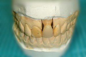 Коронка зуба искусственная