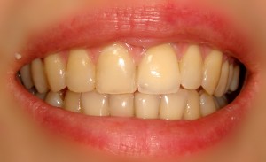 Коронка зуба искусственная