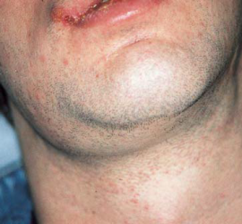 Лимфаденит