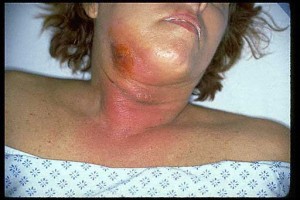 Лимфангоит