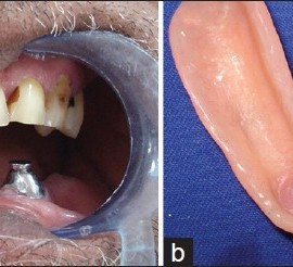 Магниты для фиксации протезов