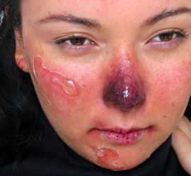 Обморожение лица