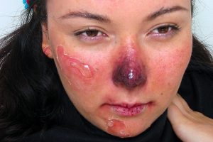 Обморожение лица