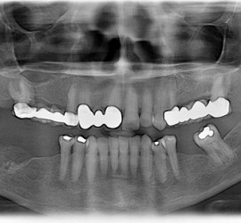 Остеомиелит одонтогенный острый
