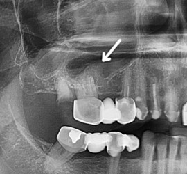 Гайморит одонтогенный хронический