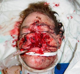 Ранения и повреждения лица огнестрельные