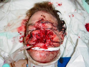 Ранения и повреждения лица огнестрельные