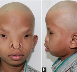 Орбитальный гипертелоризм