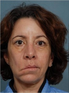 Паралич мимических мышц