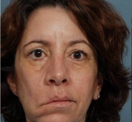 Паралич мимических мышц