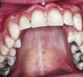 Переломы альвеолярного отростка