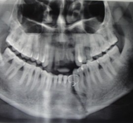 Переломы нижней челюсти