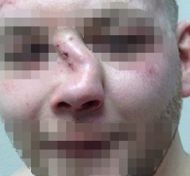 Перелом костей носа