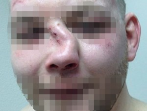 Перелом костей носа