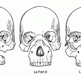 Переломы верхней челюсти