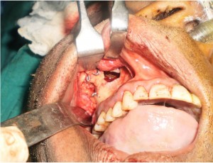 Перелом скуловой кости