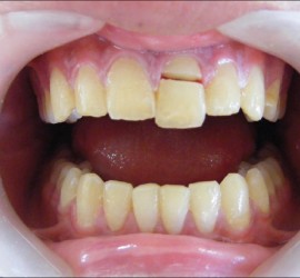 Перелом зуба