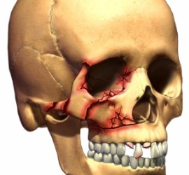 Переломы костей лица