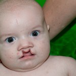 Врождённая расщелина губы