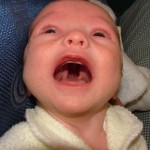 Врождённая расщелина нёба