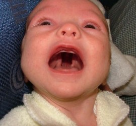 Врождённая расщелина нёба