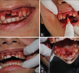 Реплантация зубов