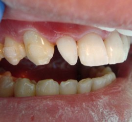 Шиповидные зубы