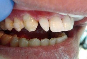 Шиповидные зубы