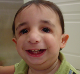 Врожденные черепно-лицевые деформации