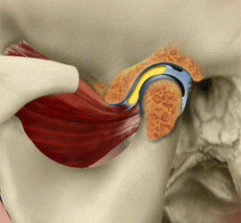 Вывих височно-нижнечелюстного сустава