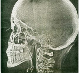 Электрорентгенография (ксерорадиография)
