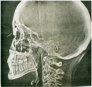 Электрорентгенография (ксерорадиография)