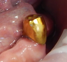 Коронка металлическая без облицовки